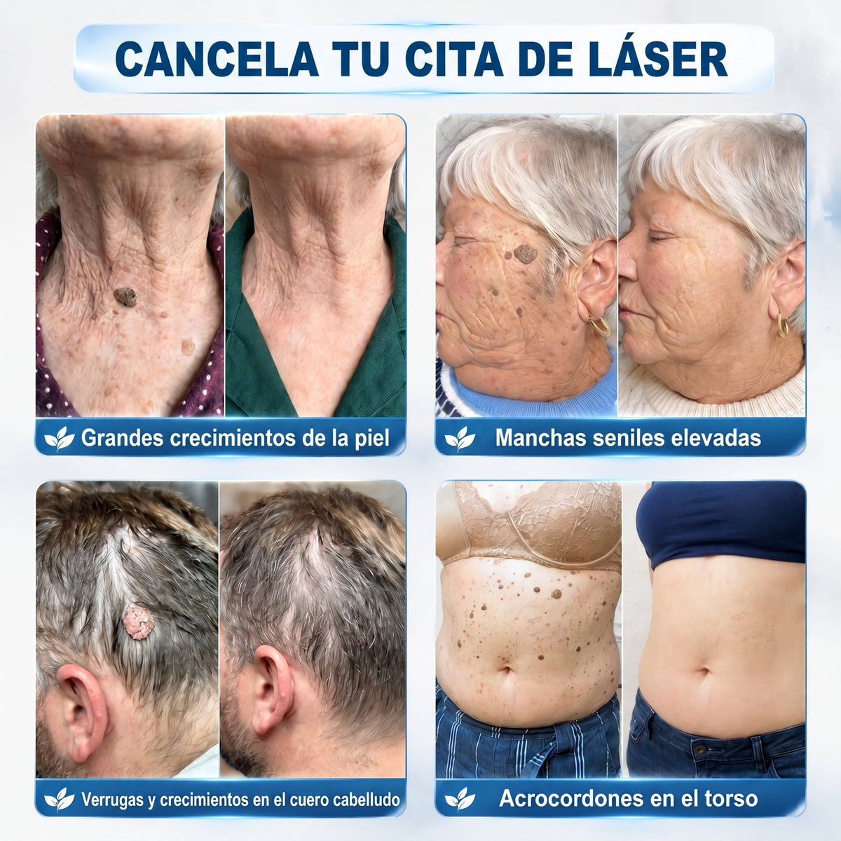 👩‍⚕️🥇𝑻𝒊𝒆𝒏𝒅𝒂 𝑶𝒇𝒊𝒄𝒊𝒂𝒍 | 𝑵𝐞𝒌𝐢𝐬𝐬® 🌿 𝑀𝑖𝑐𝑟𝑜𝑎𝑔𝑢𝑗𝑎𝑠 𝑃𝑖𝑒𝑙 𝐼𝑚𝑝𝑒𝑐𝑎𝑏𝑙𝑒 𝐸𝑙𝑖𝑚𝑖𝑛𝑎𝑐𝑖ó𝑛 𝐷𝑒 𝑉𝑒𝑟𝑟𝑢𝑔𝑎𝑠 𝑃𝑎𝑟𝑐ℎ𝑒 (𝑃𝑎𝑟𝑎 𝑎𝑐𝑟𝑜𝑐𝑜𝑟𝑑𝑜𝑛𝑒𝑠, 𝑝𝑒𝑞𝑢𝑒ñ𝑎𝑠 𝑖𝑚𝑝𝑒𝑟𝑓𝑒𝑐𝑐𝑖𝑜𝑛𝑒𝑠 𝑐𝑢𝑡á𝑛𝑒𝑎𝑠, 𝑣𝑒𝑟𝑟𝑢𝑔𝑎𝑠, 𝑙𝑢𝑛𝑎𝑟𝑒𝑠, 𝑚𝑎𝑛𝑐ℎ𝑎𝑠 𝑑𝑒 𝑙𝑎 𝑒𝑑𝑎𝑑 𝑦 𝑝𝑟𝑜𝑏𝑙𝑒𝑚𝑎𝑠 𝑑𝑒 𝑝𝑖𝑔𝑚𝑒𝑛𝑡𝑎𝑐𝑖ó𝑛.)